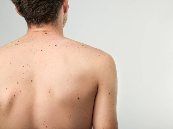 birthmarks on human body