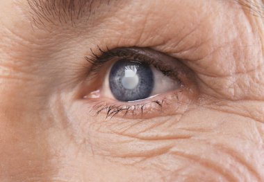 Cataract concept. Senior woman's eye, closeup clipart