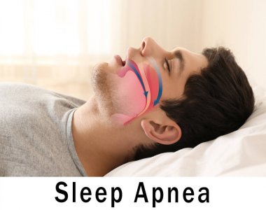 Snore problem concept. Illustration of obstructive sleep apnea clipart