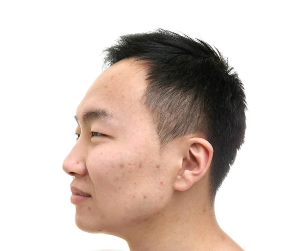 Jeune asiatique homme avec problème de peau sur fond blanc — Photo