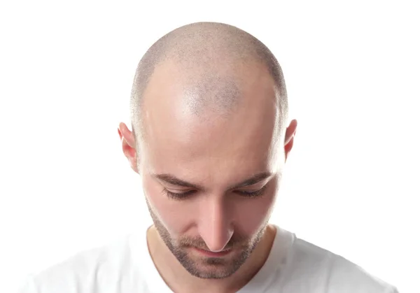 Conceito de perda de cabelo. Cabeça de homem sobre fundo branco, close-up — Fotografia de Stock