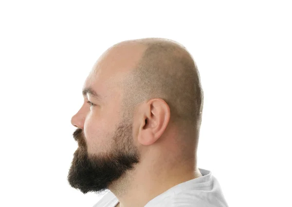 Bald adult man — Stock Photo, Image