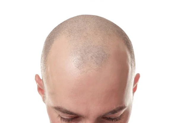 Hair loss concept. Head of man on white background, closeup — Stock Photo, Image