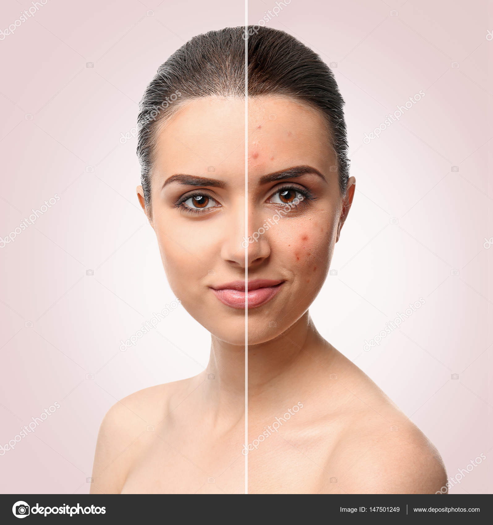 Woman face before and after acne treatment procedure. Skin care concept
