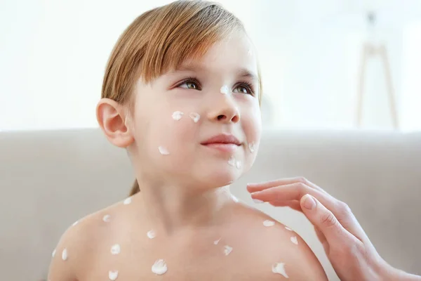 Mão Feminina Aplicando Creme Pele Criança Doente Com Varicela Fundo — Fotografia de Stock