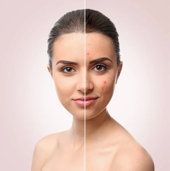 Mujer cara antes y después del procedimiento de tratamiento del acné. Concepto de cuidado de la piel . — Foto de Stock