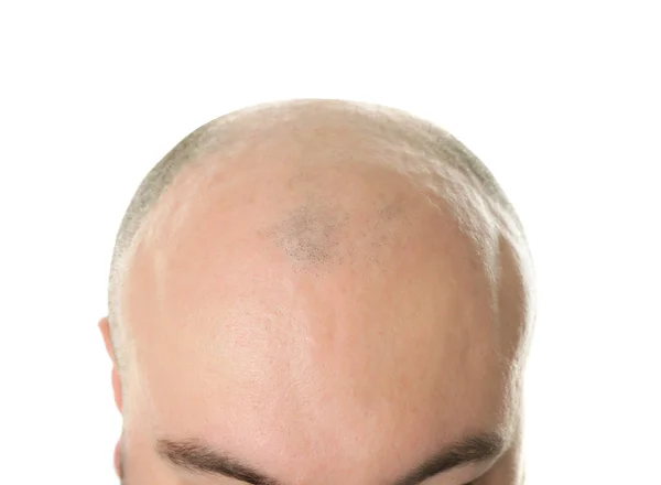 Bald adult man — Stock Photo, Image