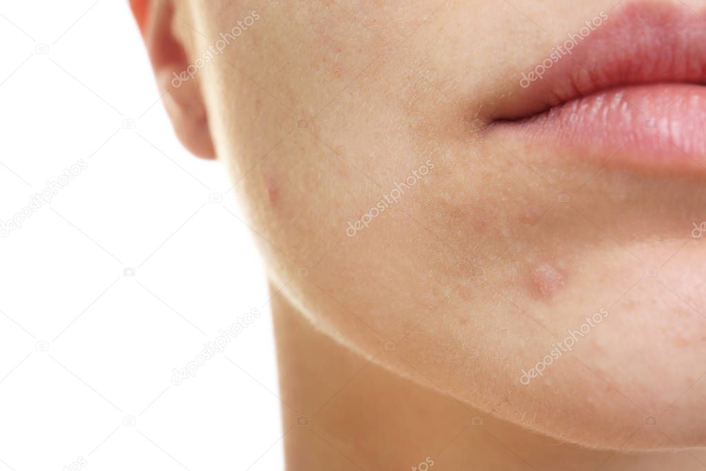 woman with problem skin