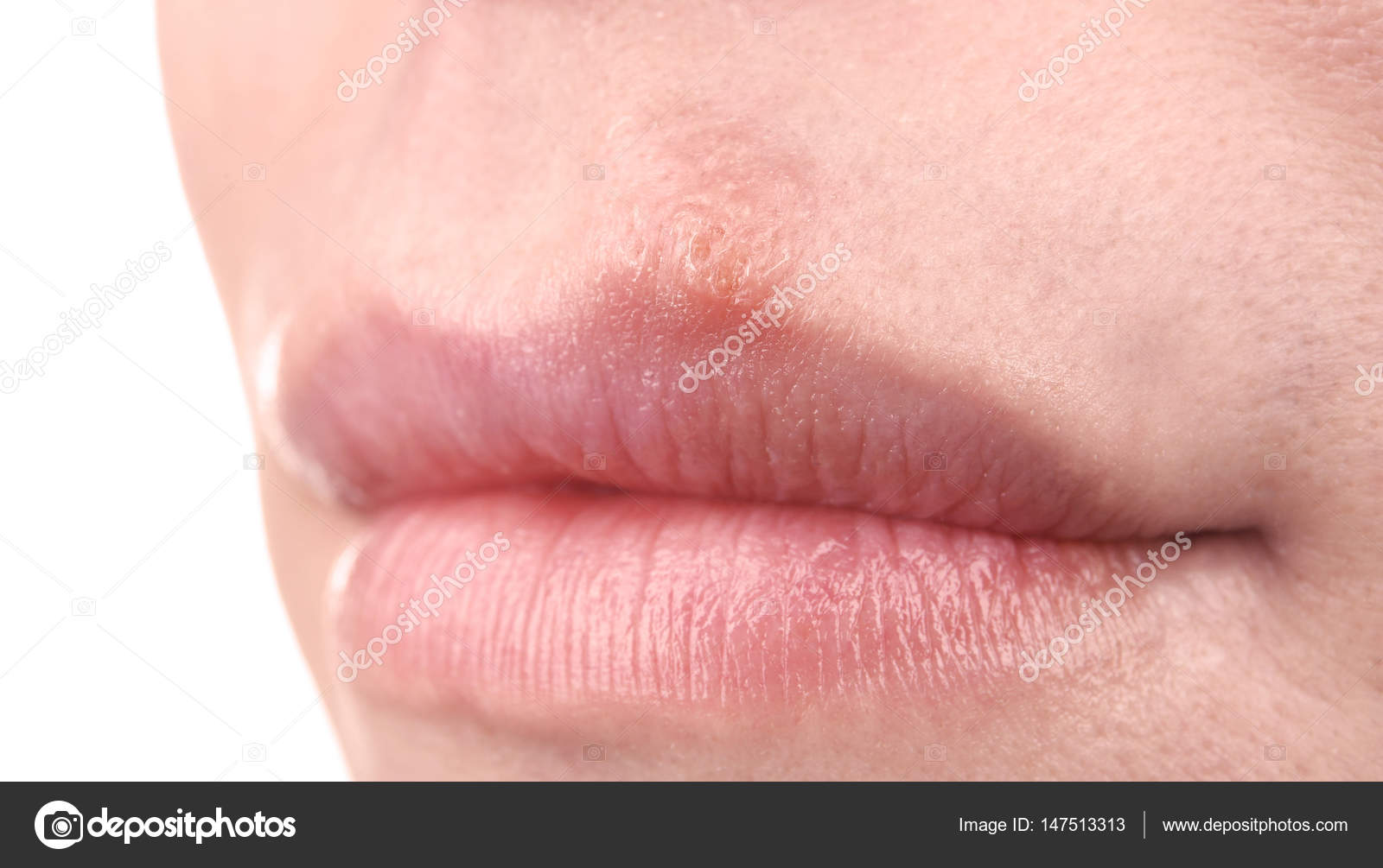 хейлит манганотти предрак. фордайса инфекционный. герпетическая сыпь на губах. губа выступить. хейлит мелькерссона -розенталя.