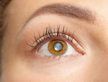 Cataract concept. Young woman's eye, closeup clipart