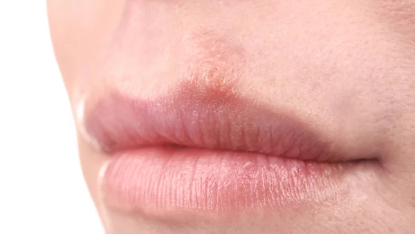 Herpesz hólyagok női ajkak — Stock Fotó