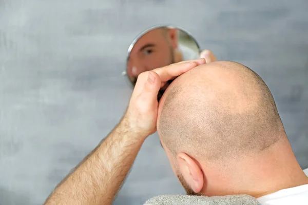 Homem adulto com problema de perda de cabelo — Fotografia de Stock