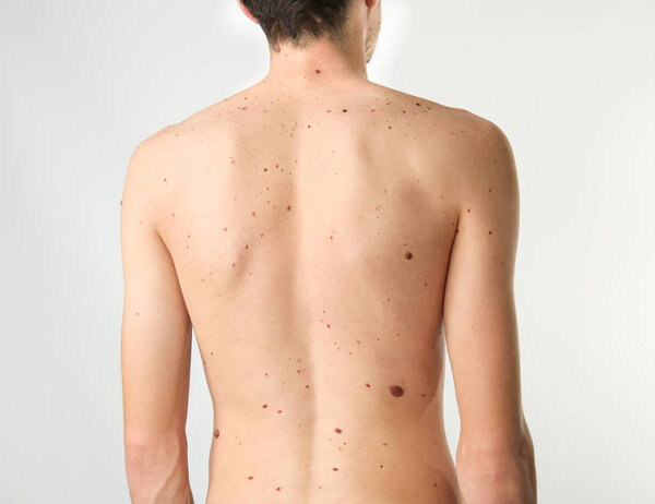 birthmarks on human body