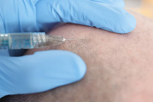 Man Met Haar Verlies Probleem Ontvangende Injectie Kliniek Close — Stockfoto