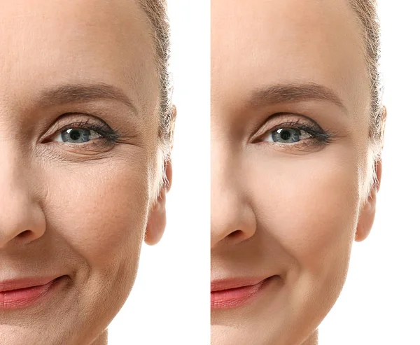 Rosto antes e depois do procedimento cosmético — Fotografia de Stock