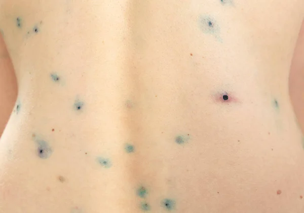 Doente humano com varíola de frango — Fotografia de Stock