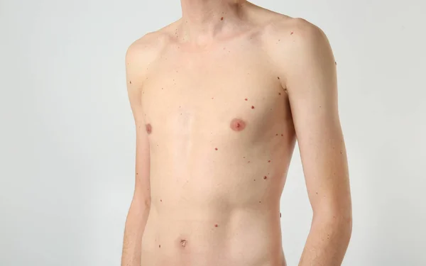 Birthmarks on human body — Stock Photo, Image