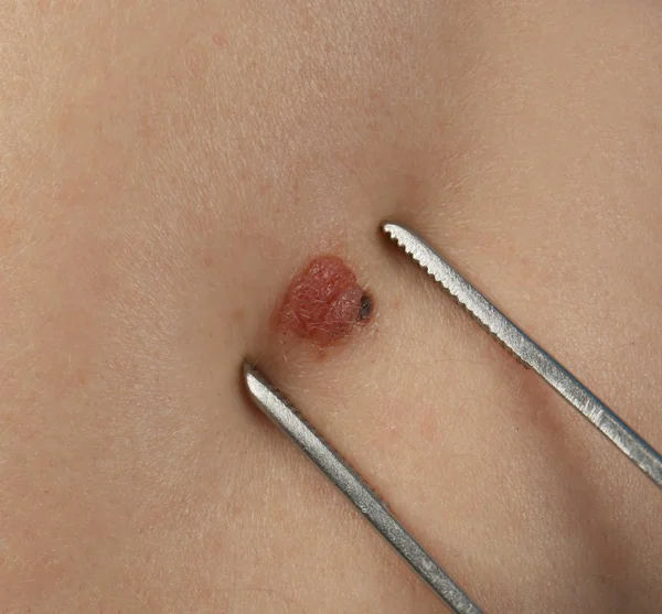 Removal of birthmark in clinic, closeup — Stock Photo, Image