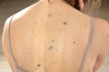 kadın Tavuk Pox'u ile hasta