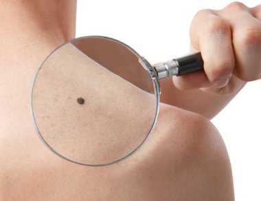 birthmarks on human body clipart