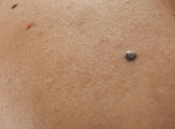 birthmarks on human body