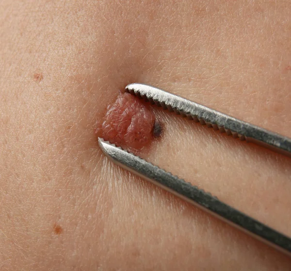 Removal of birthmark in clinic, closeup — Stock Photo, Image