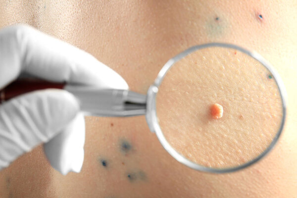 Dermatologist looking at skin of human with birthmark through magnifier, closeup