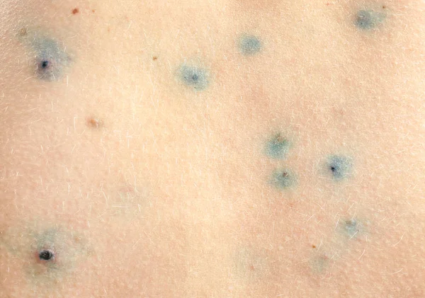 Human ill with chicken pox — Stock Photo, Image