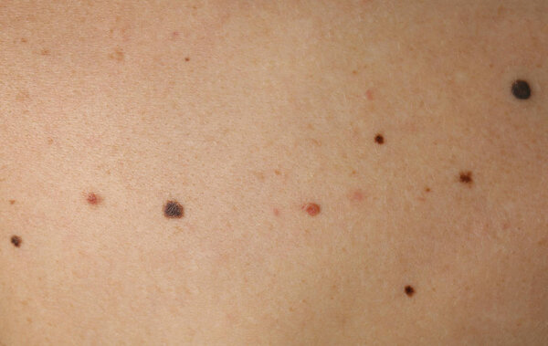 birthmarks on human body