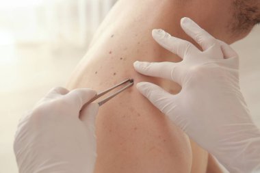 Klinikte, closeup doğum lekesi çıkarma dermatolog