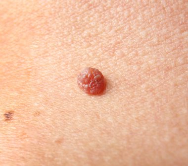 Doğum lekesi ile insan derisi 