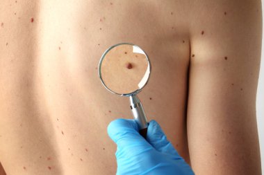 Büyüteç'i muayene hastada klinik, closeup ile dermatolog