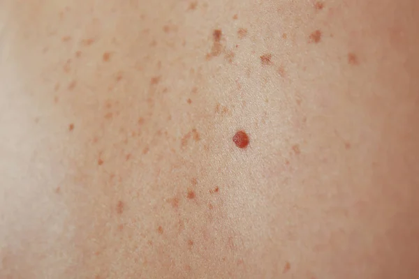 Human skin with birthmarks — Stock Photo, Image