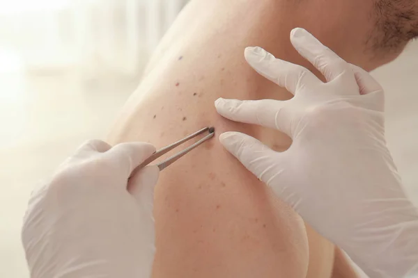 Dermatolog usuwanie znamienia w klinice, zbliżenie — Zdjęcie stockowe