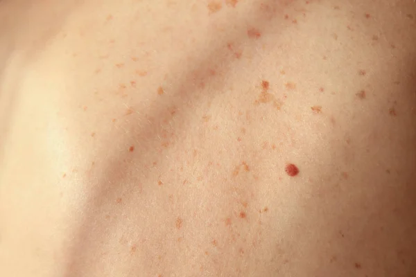 Human skin with birthmarks — Stock Photo, Image