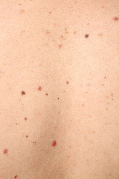 Human skin with birthmarks 