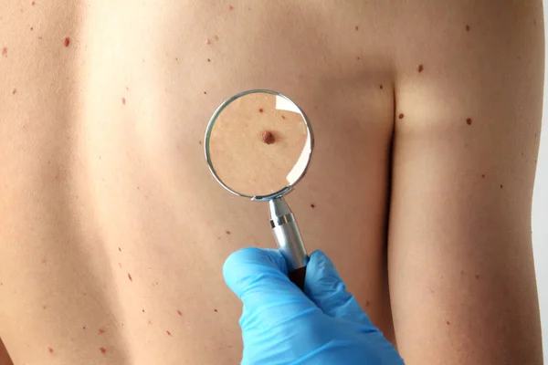 Dermatologista com lupa examinando paciente na clínica, close-up — Fotografia de Stock