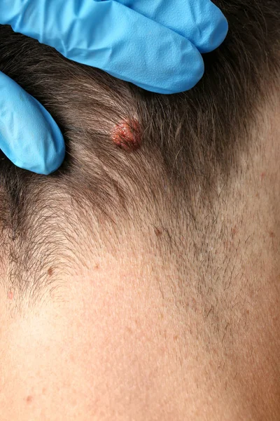 Dermatolog undersöker patienten på kliniken, närbild — Stockfoto