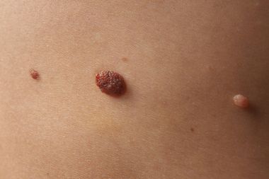 İnsan derisi ile doğum lekeleri 