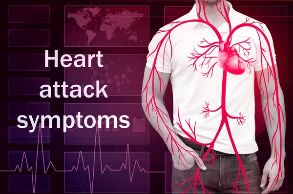 Modelo médico de ataque cardíaco — Fotografia de Stock