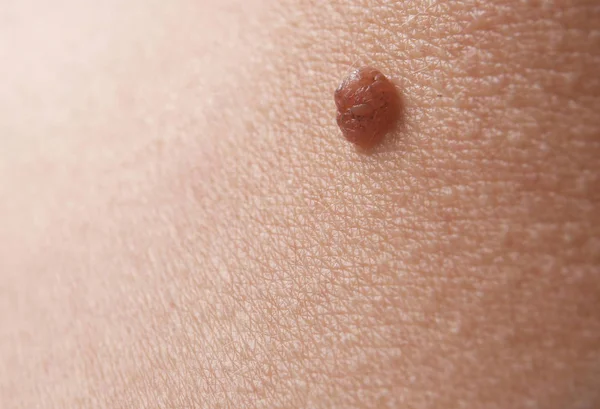 Человеческая кожа с родимым пятном — стоковое фото