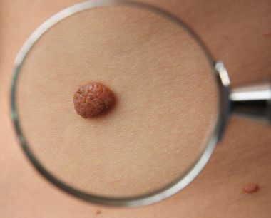 Doğum lekesi Büyüteç aracılığıyla bakarak