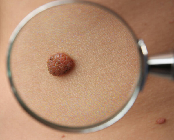 Looking at birthmark through magnifier