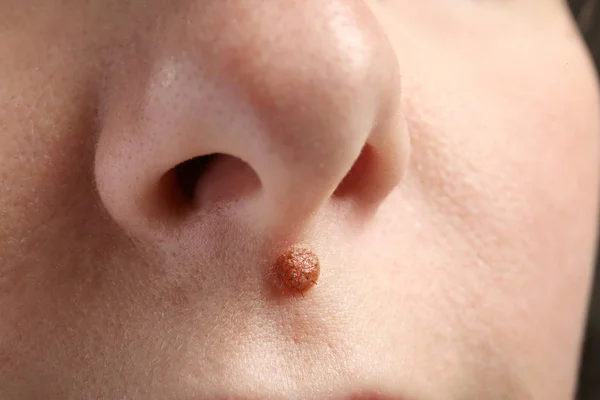 Marca de nascença no rosto da jovem, close-up — Fotografia de Stock