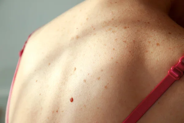 Young woman with problem skin in clinic, closeup — Stock Photo, Image