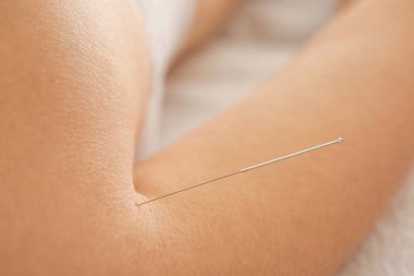 Akupunktur iğnesi iğneleyici