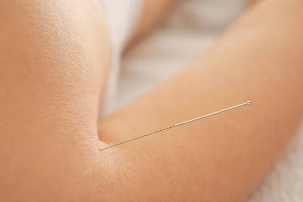 Pricking acupuncture needle — Stock Photo, Image