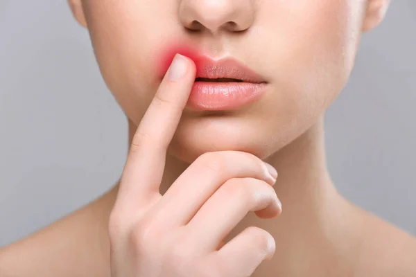 Lábios femininos com vírus herpes — Fotografia de Stock