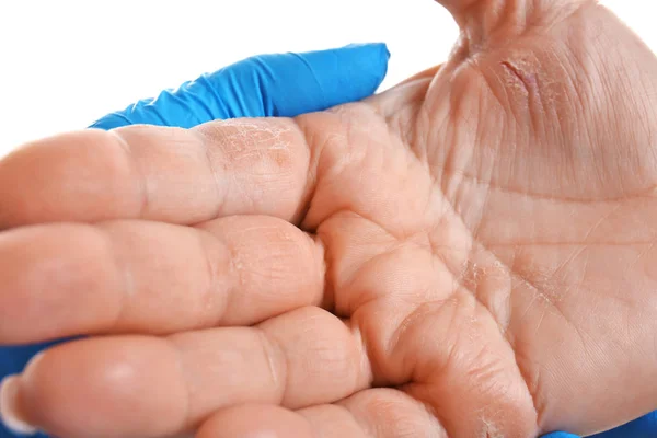 Medico esaminando paziente con dermatite a portata di mano — Foto Stock