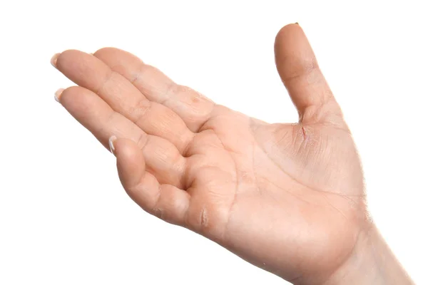 Weibliche Hand mit Dermatitis — Stockfoto